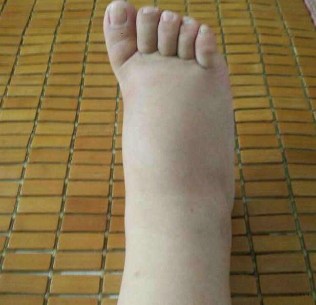 癌症晚期很多患者都会出现手脚水肿情况,这属于常见并发症之一,严重者